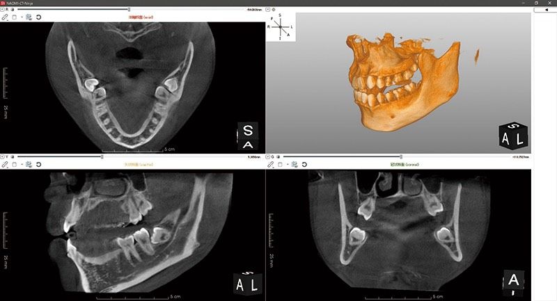 歯科用CTの画像（断面と3D表示）