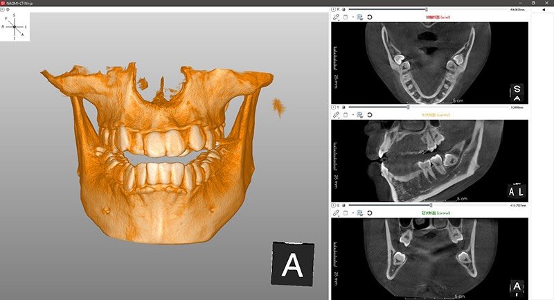 歯科用CTで撮影した3D画像